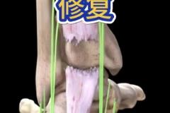 看着都疼啊!科普帖:球员脚跟腱断裂是如何进行修复的?